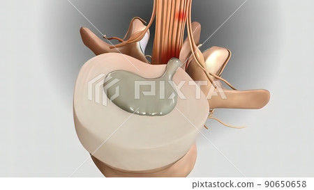 3D illustration of the destruction of discs and compression of nerve 3D illustration of the destruction of discs and compression of nerve 90650658