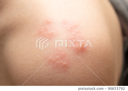 Skin stung by caterpillars 90653792