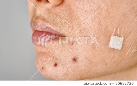 Facial skin problem, Acne disease in adult, Close up woman face with whitehead pimples Facial skin problem, Acne disease in adult, Close up woman face with whitehead pimples 90692726
