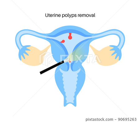 uterine polyp endometrial uterine polyp endometrial 90695263