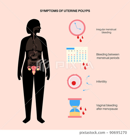 Uterus Polyps Disease 90695270