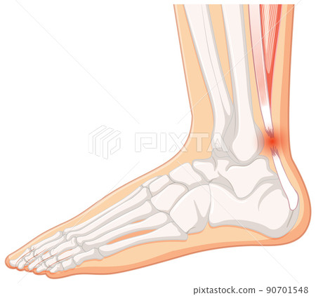 Achilles tendo rupture on white background 90701548