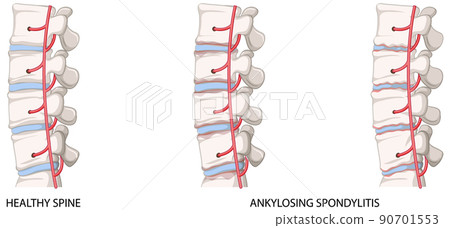 Infographic of healthy spine and ankylosing spondylitis 90701553