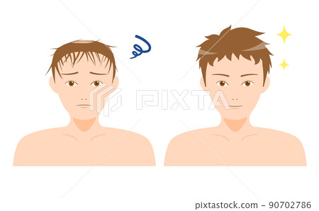 AGA Thinning Hair Alopecia Male Before After AGA Thinning Hair Alopecia Male Before After 90702786