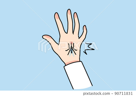 Mosquito bite person hand  90711831