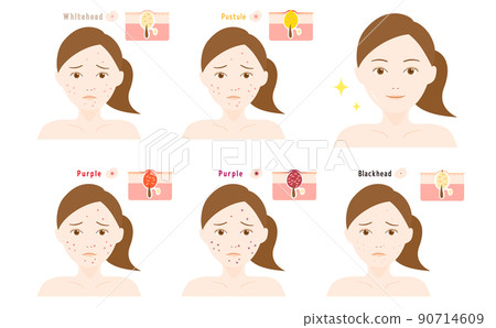 Cross section of acne woman's face and skin Cross section of acne woman's face and skin 90714609