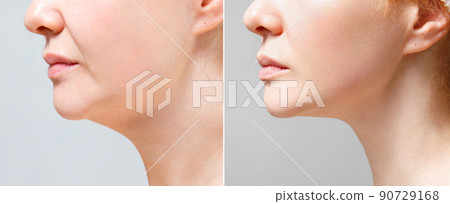 A close portrait of an aged woman before and after facial rejuvenation procedure. Correction of the chin shape liposuction of the neck. The result of the procedure in the clinic of aesthetic medicine. 90729168