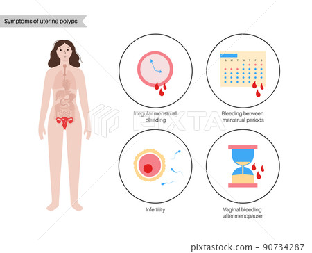Uterus Polyps Disease 90734287