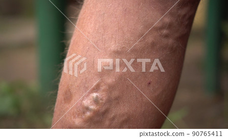 Close-up of varicose veins and age spots on a human leg. Close-up of varicose veins and age spots on a human leg. 90765411