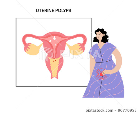 Uterus Polyps Disease Uterus Polyps Disease 90770955