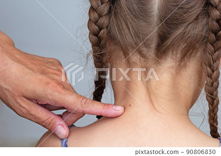 Adult finger showing birthmark on child neck back 90806830