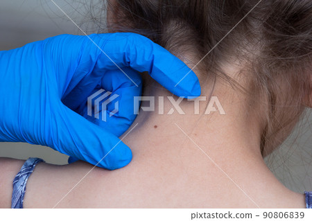 Birthmark on child neck 90806839