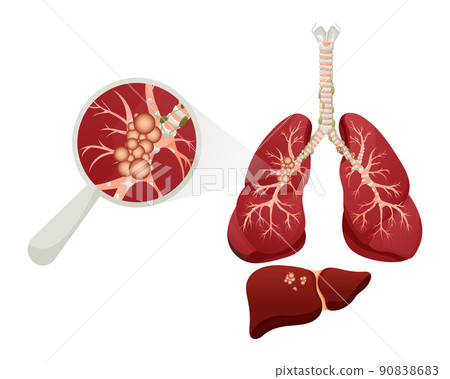 Diagram lung cancer disease. Concept disease human internal organs. Vector illustration, cartoon style. Diagram lung cancer disease. Concept disease human internal organs. Vector illustration, cartoon style. 90838683