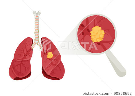 Diagram lung cancer disease. Concept disease human internal organs. Vector illustration, cartoon style. Diagram lung cancer disease. Concept disease human internal organs. Vector illustration, cartoon style. 90838692