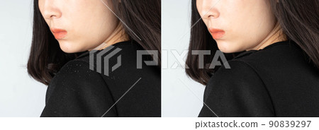 Before and after treatment dandruff and seborrheic dermatitis. Long black hair woman looking at hair flakes on her shoulder. Hair care concept. Before and after treatment dandruff and seborrheic dermatitis. Long black hair woman looking at hair flakes on her shoulder. Hair care concept. 90839297