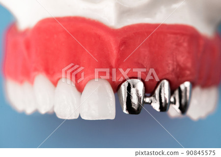 Teeth implant and crown installation process parts isolated on a blue background. Medically accurate 3D model.  90845575