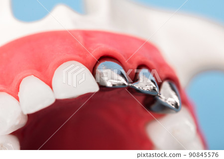 Teeth implant and crown installation process parts isolated on a blue background. Medically accurate 3D model.  90845576