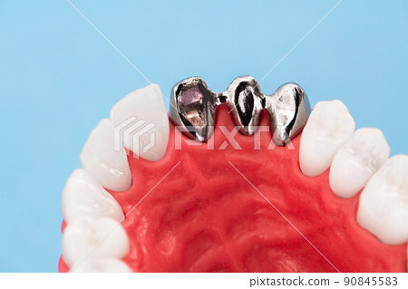 Teeth implant and crown installation process parts isolated on a blue background. Medically accurate 3D model. Teeth implant and crown installation process parts isolated on a blue background. Medically accurate 3D model. 90845583