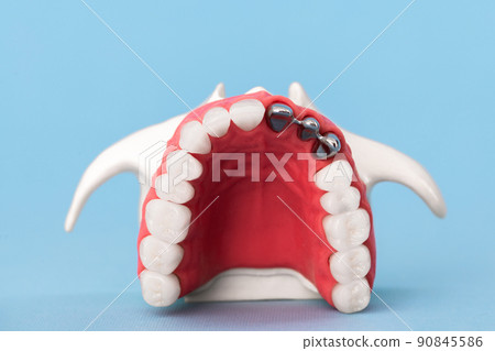 Teeth implant and crown installation process parts isolated on a blue background. Medically accurate 3D model. Teeth implant and crown installation process parts isolated on a blue background. Medically accurate 3D model. 90845586