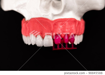 Teeth implant and crown installation process parts isolated on a blue background. Medically accurate 3D model. Teeth implant and crown installation process parts isolated on a blue background. Medically accurate 3D model. 90845588