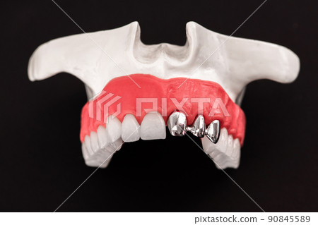 Teeth implant and crown installation process parts isolated on a blue background. Medically accurate 3D model.  90845589