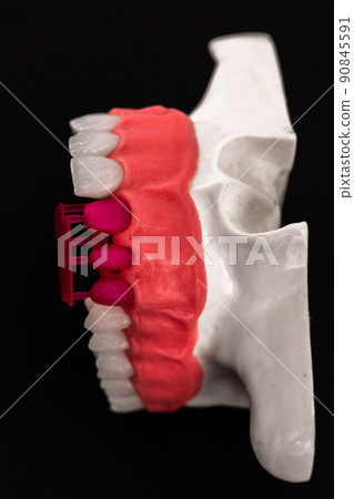 Teeth implant and crown installation process parts isolated on a blue background. Medically accurate 3D model. Teeth implant and crown installation process parts isolated on a blue background. Medically accurate 3D model. 90845591