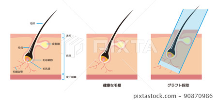 髮根和稀疏頭髮的橫截面解剖 / AGA 自己的頭髮移植 90870986