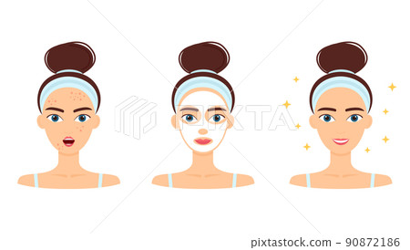 Young woman with acne. Treatment, before and after skincare. Face mask, beauty concept, vector illustration 90872186