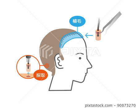 Hair transplantation / transplantation method (graft collection / implant) 90873270