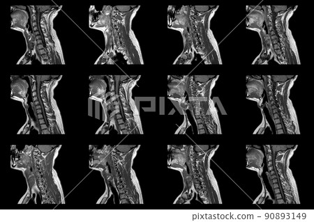 set of sagittal MRI scans of neck area of caucasian male with bilateral paramedial extrusion of the C6-C7 segment with radiculopathy set of sagittal MRI scans of neck area of caucasian male with bilateral paramedial extrusion of the C6-C7 segment with radiculopathy 90893149