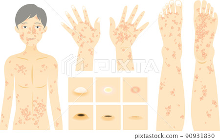 猴痘皮膚症狀和狀況變化的圖像 面部、身體、手和腳、傳染病病毒 90931830