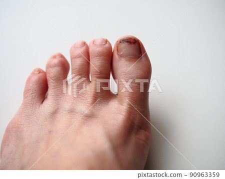 踩到時會破裂並流血的縮略圖 踩到時會破裂並流血的縮略圖 90963359