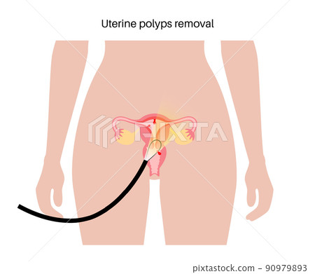 Uterus Polyps Disease 90979893