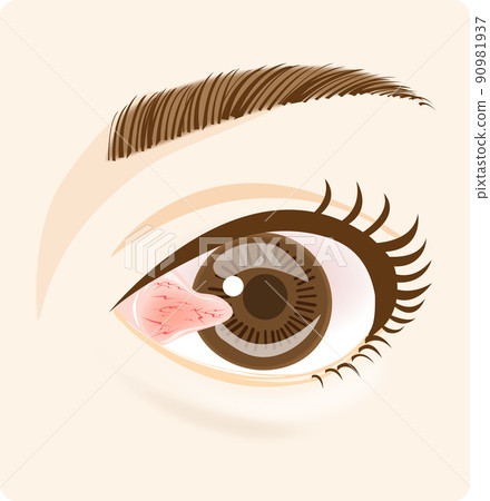 Pterygium (inner corner of the eye) 90981937
