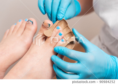 Podiatrist in blue gloves inserts a silicone impression to fix the ingrown toenail on the client's big toe. Close-up. The concept of podology and chiropody 90984252