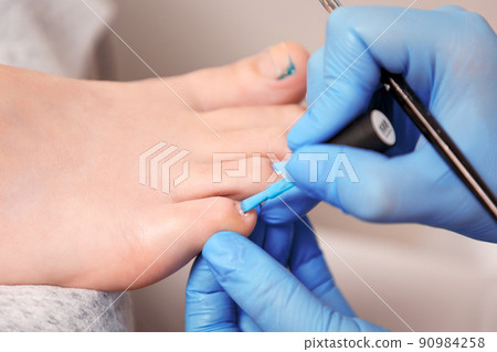 A master pedicurist paints the client's toenails. Person's big toe with titanium thread for correction of ingrown toenail. Close-up. The concept of podology and chiropody 90984258
