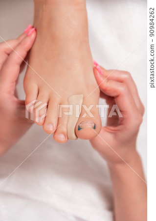 Podiatrist inserts a silicone impression between the toes to correct the ingrown toenail on the thumb. Close-up. Vertical orientation. The concept of podology and chiropody 90984262