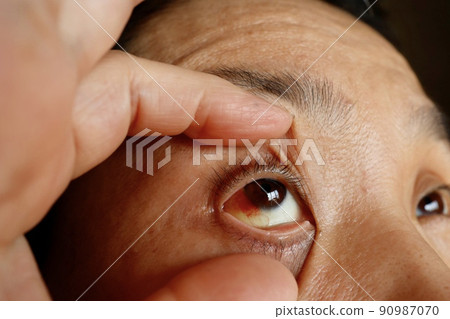 Subconjunctival bleeding 90987070