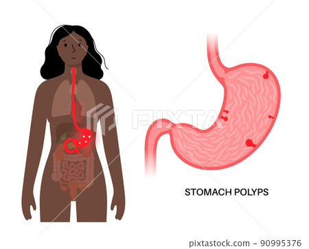 Stomach polyp disease Stomach polyp disease 90995376