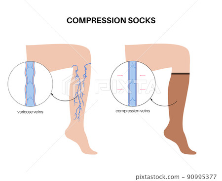 Compression stocking pressure Compression stocking pressure 90995377