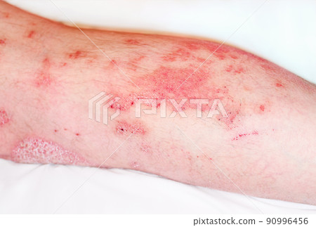 Large red,inflamed,scaly rash on man's legs.Acute psoriasis, severe reddening of the skin,an autoimmune,incurable dermatological skin disease.Joints affected by psoriatic arthritis. Large red,inflamed,scaly rash on man's legs.Acute psoriasis, severe reddening of the skin,an autoimmune,incurable dermatological skin disease.Joints affected by psoriatic arthritis. 90996456
