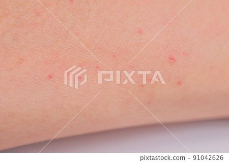 手臂紅色濕疹、紅斑丘疹、皮炎 91042626