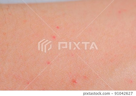 Red eczema on the arm, erythema papule, dermatitis 91042627