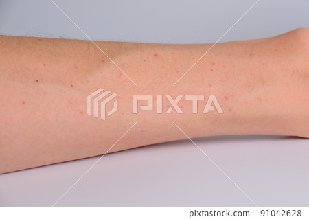 Red eczema on the arm, erythema papule, dermatitis 91042628