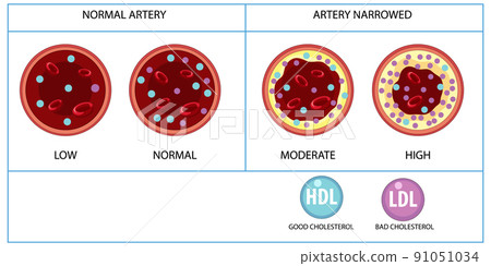Types of Cholesterol HDL and LDL 91051034