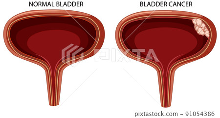 Stage of bladder cancer 91054386
