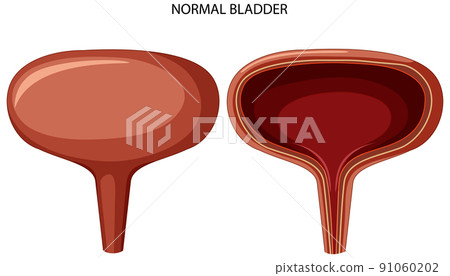 Stage of bladder cancer Stage of bladder cancer 91060202