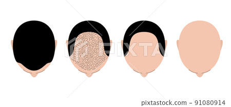 Hair loss bald head alopecia transplant growth vector top view. Hair loss men top view alopecia 91080914