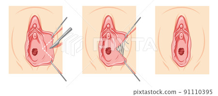 Labiaplasty Female reproductive system process and ready uterus. Vaginoplasty Front view. Human Surface anatomy perineum Labiaplasty Female reproductive system process and ready uterus. Vaginoplasty Front view. Human Surface anatomy perineum 91110395