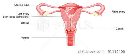 Asherman syndrome Female reproductive system scar tissue adhesions in uterus diagram with inscriptions. Front view  91110400